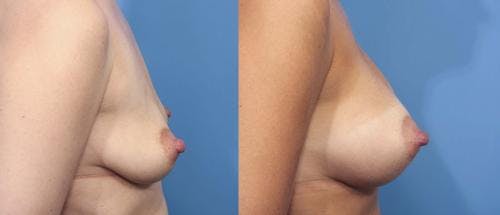 Breast Augmentation Before & After Gallery - Patient 58470358 - Image 2
