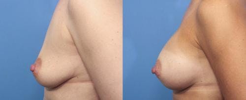 Breast Augmentation Before & After Gallery - Patient 58470358 - Image 3