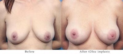 Breast Augmentation Before & After Gallery - Patient 58470359 - Image 1
