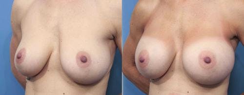 Breast Augmentation Before & After Gallery - Patient 58470360 - Image 2