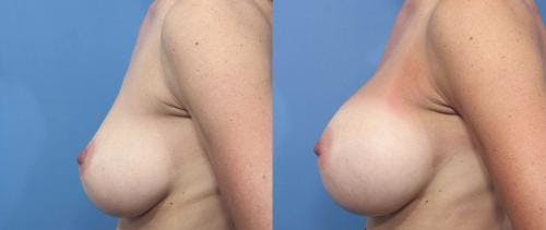 Breast Augmentation Before & After Gallery - Patient 58470360 - Image 3