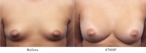 Breast Augmentation Before & After Gallery - Patient 58470362 - Image 1