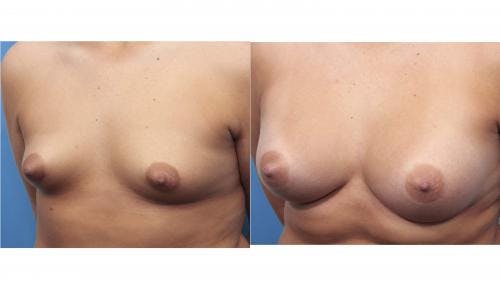 Breast Augmentation Before & After Gallery - Patient 58470362 - Image 2