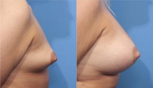 Breast Augmentation Before & After Gallery - Patient 58470362 - Image 3