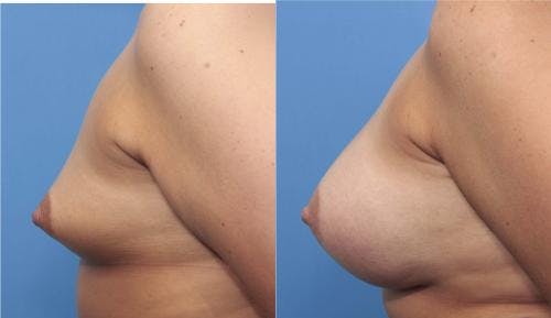 Breast Augmentation Before & After Gallery - Patient 58470362 - Image 4