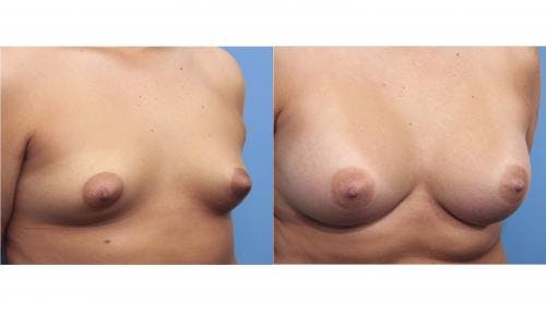 Breast Augmentation Before & After Gallery - Patient 58470362 - Image 5