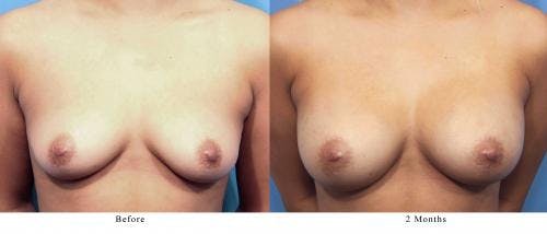 Breast Augmentation Before & After Gallery - Patient 58470364 - Image 1