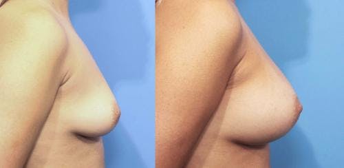 Breast Augmentation Before & After Gallery - Patient 58470364 - Image 2