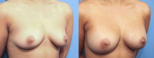 Breast Augmentation Before & After Gallery - Patient 58470364 - Image 3