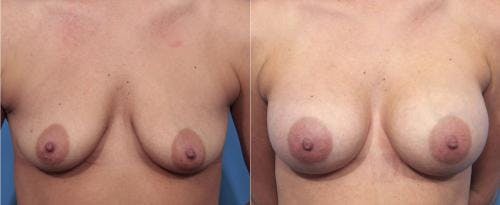 Breast Augmentation Before & After Gallery - Patient 58470365 - Image 1