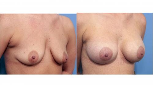 Breast Augmentation Before & After Gallery - Patient 58470365 - Image 2