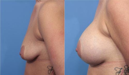 Breast Augmentation Before & After Gallery - Patient 58470365 - Image 3