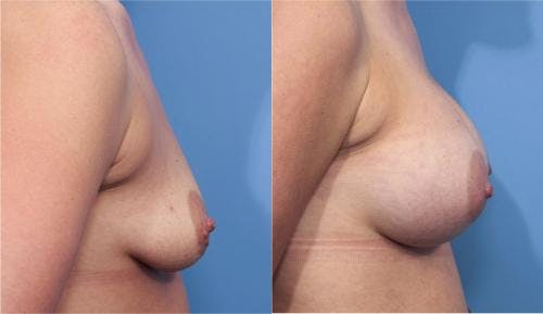 Breast Augmentation Before & After Gallery - Patient 58470365 - Image 4