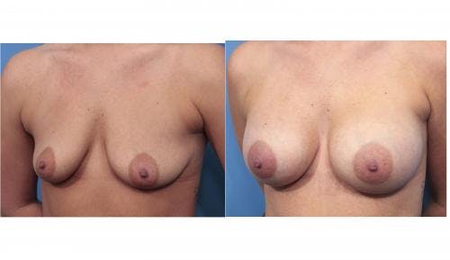 Breast Augmentation Before & After Gallery - Patient 58470365 - Image 5