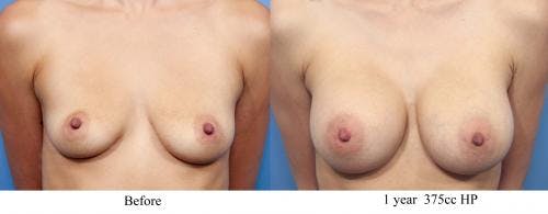Breast Augmentation Before & After Gallery - Patient 58470366 - Image 1
