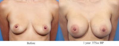 Breast Augmentation Before & After Gallery - Patient 58470366 - Image 1