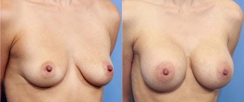 Breast Augmentation Before & After Gallery - Patient 58470366 - Image 2