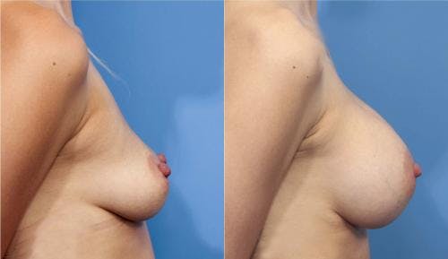 Breast Augmentation Before & After Gallery - Patient 58470366 - Image 3