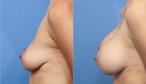 Breast Augmentation Before & After Gallery - Patient 58470366 - Image 4