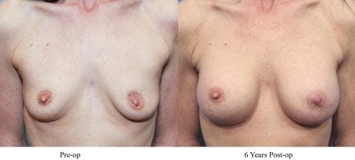Breast Augmentation Before & After Gallery - Patient 58470367 - Image 1