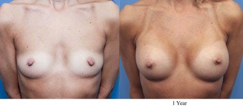 Breast Augmentation Before & After Gallery - Patient 58470368 - Image 1