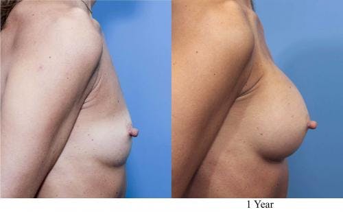Breast Augmentation Before & After Gallery - Patient 58470368 - Image 2