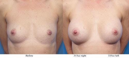 Breast Augmentation Before & After Gallery - Patient 58470370 - Image 1
