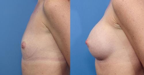 Breast Augmentation Before & After Gallery - Patient 58470370 - Image 2