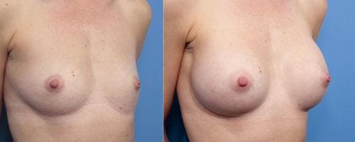 Breast Augmentation Before & After Gallery - Patient 58470370 - Image 3