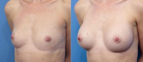 Breast Augmentation Before & After Gallery - Patient 58470370 - Image 4