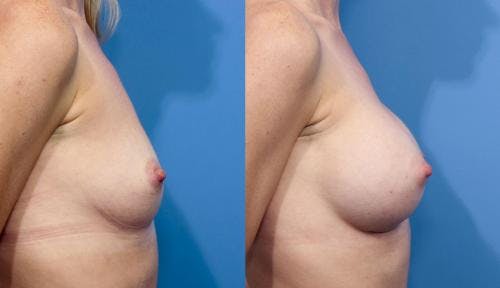 Breast Augmentation Before & After Gallery - Patient 58470370 - Image 5