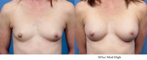 Breast Augmentation Before & After Gallery - Patient 58470373 - Image 1