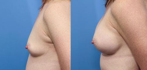 Breast Augmentation Before & After Gallery - Patient 58470373 - Image 2
