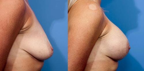 Breast Augmentation Before & After Gallery - Patient 58470437 - Image 2