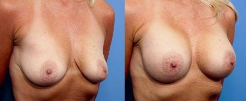 Breast Augmentation Before & After Gallery - Patient 58470437 - Image 3