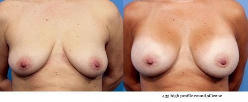 Breast Augmentation Before & After Gallery - Patient 58470439 - Image 1