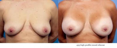 Breast Augmentation Before & After Gallery - Patient 58470439 - Image 1