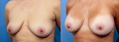 Breast Augmentation Before & After Gallery - Patient 58470439 - Image 2