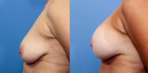 Breast Augmentation Before & After Gallery - Patient 58470439 - Image 3