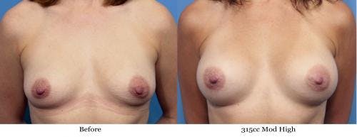 Breast Augmentation Before & After Gallery - Patient 58470442 - Image 1