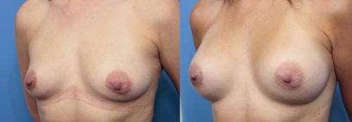 Breast Augmentation Before & After Gallery - Patient 58470442 - Image 2