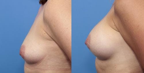 Breast Augmentation Before & After Gallery - Patient 58470442 - Image 3