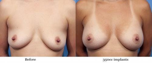 Breast Augmentation Before & After Gallery - Patient 58470443 - Image 1