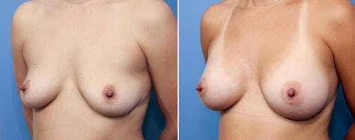 Breast Augmentation Before & After Gallery - Patient 58470443 - Image 2