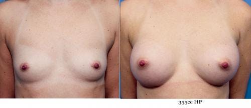 Breast Augmentation Before & After Gallery - Patient 58470444 - Image 1