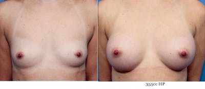 Breast Augmentation Before & After Gallery - Patient 58470444 - Image 1