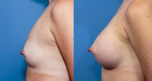 Breast Augmentation Before & After Gallery - Patient 58470444 - Image 3