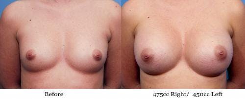 Breast Augmentation Before & After Gallery - Patient 58470447 - Image 1