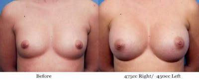 Breast Augmentation Before & After Gallery - Patient 58470447 - Image 1