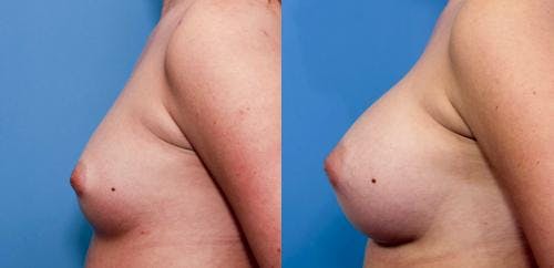 Breast Augmentation Before & After Gallery - Patient 58470447 - Image 2